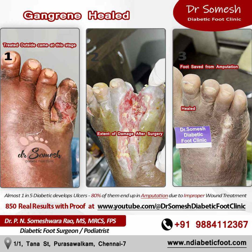 podiatrist chennai | gangrene foot