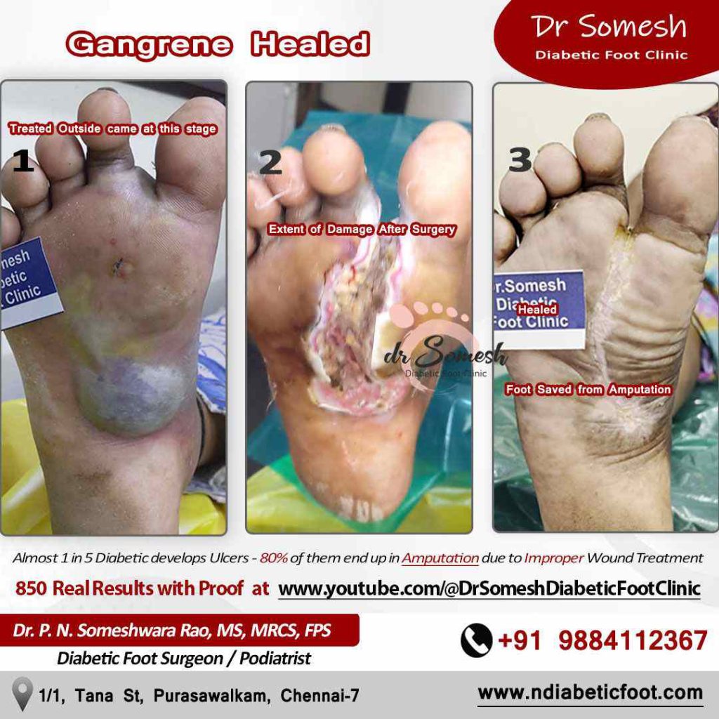 podiatrist chennai | gangrene foot