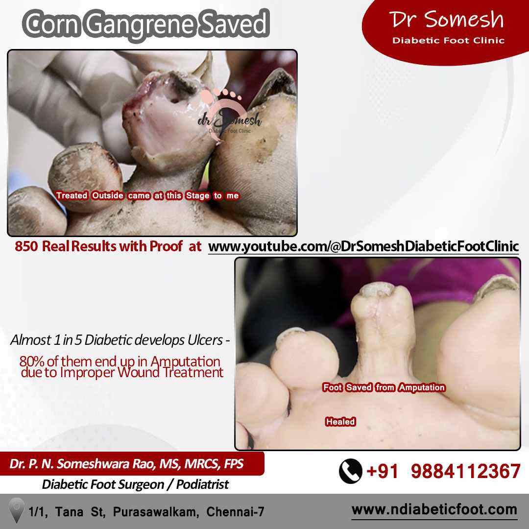 podiatrist chennai | toe gangrene