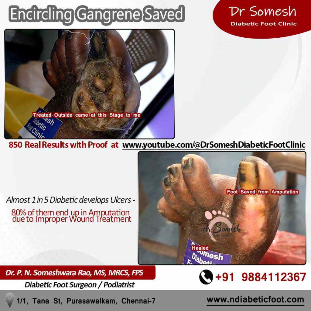 podiatrist chennai | toe gangrene