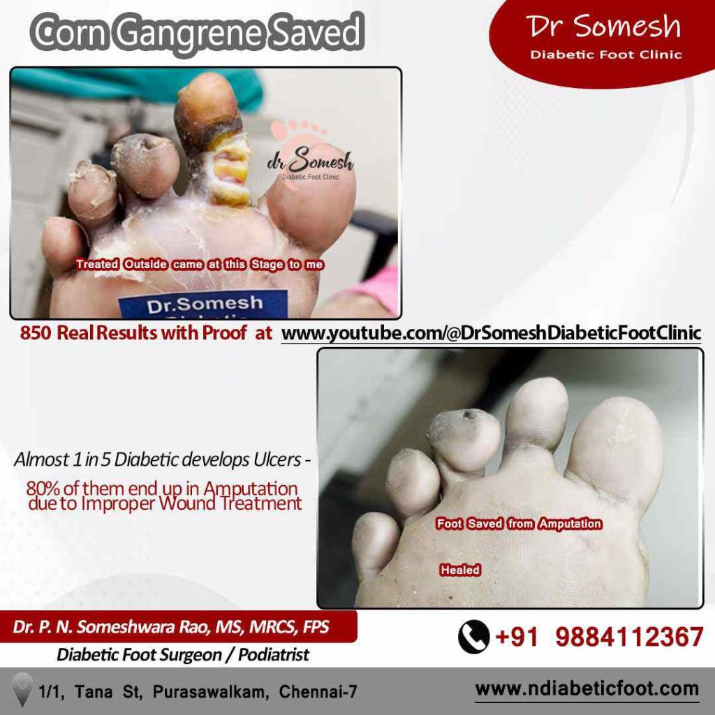 podiatrist chennai | diabetic foot ulcer