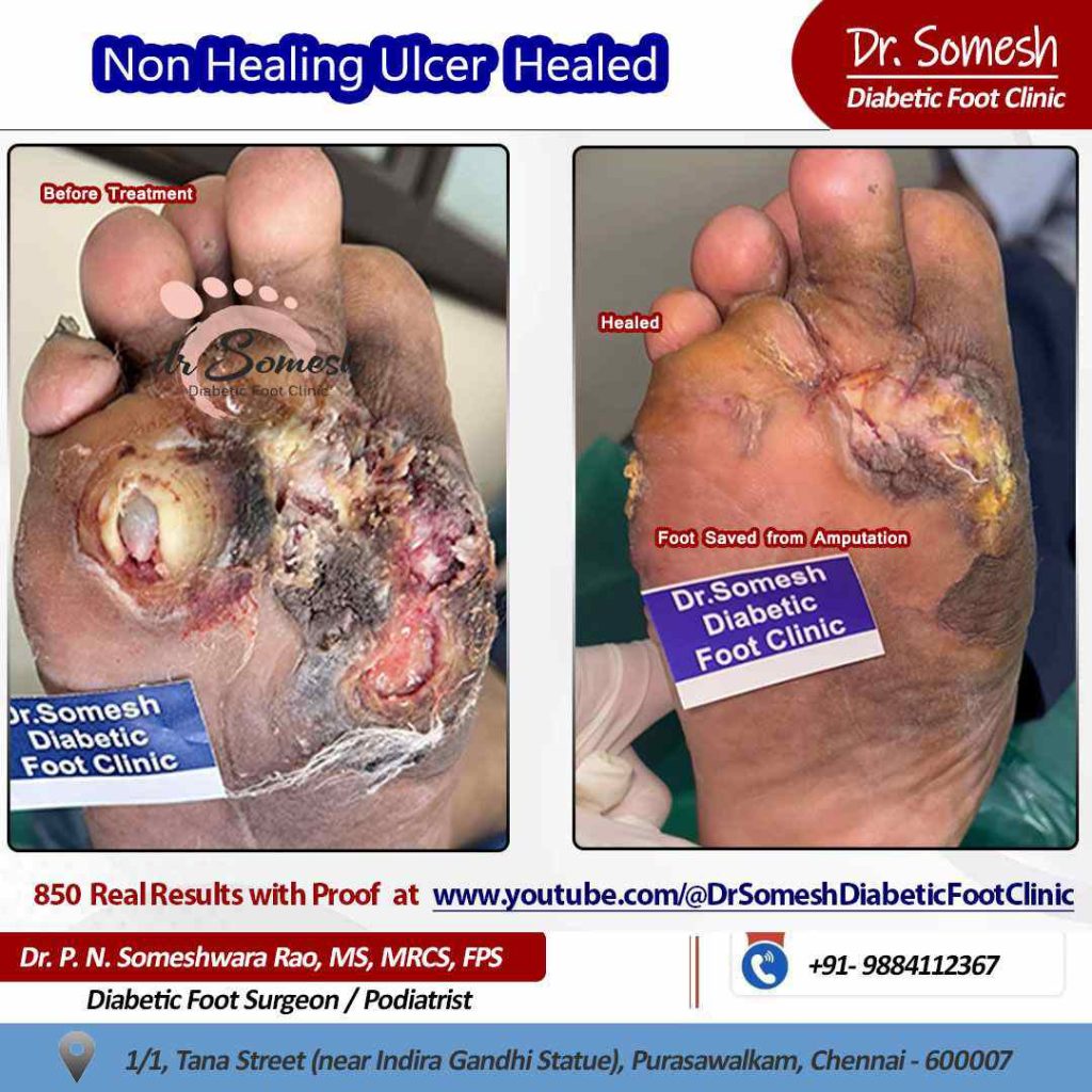 podiatrist chennai | diabetic foot ulcers