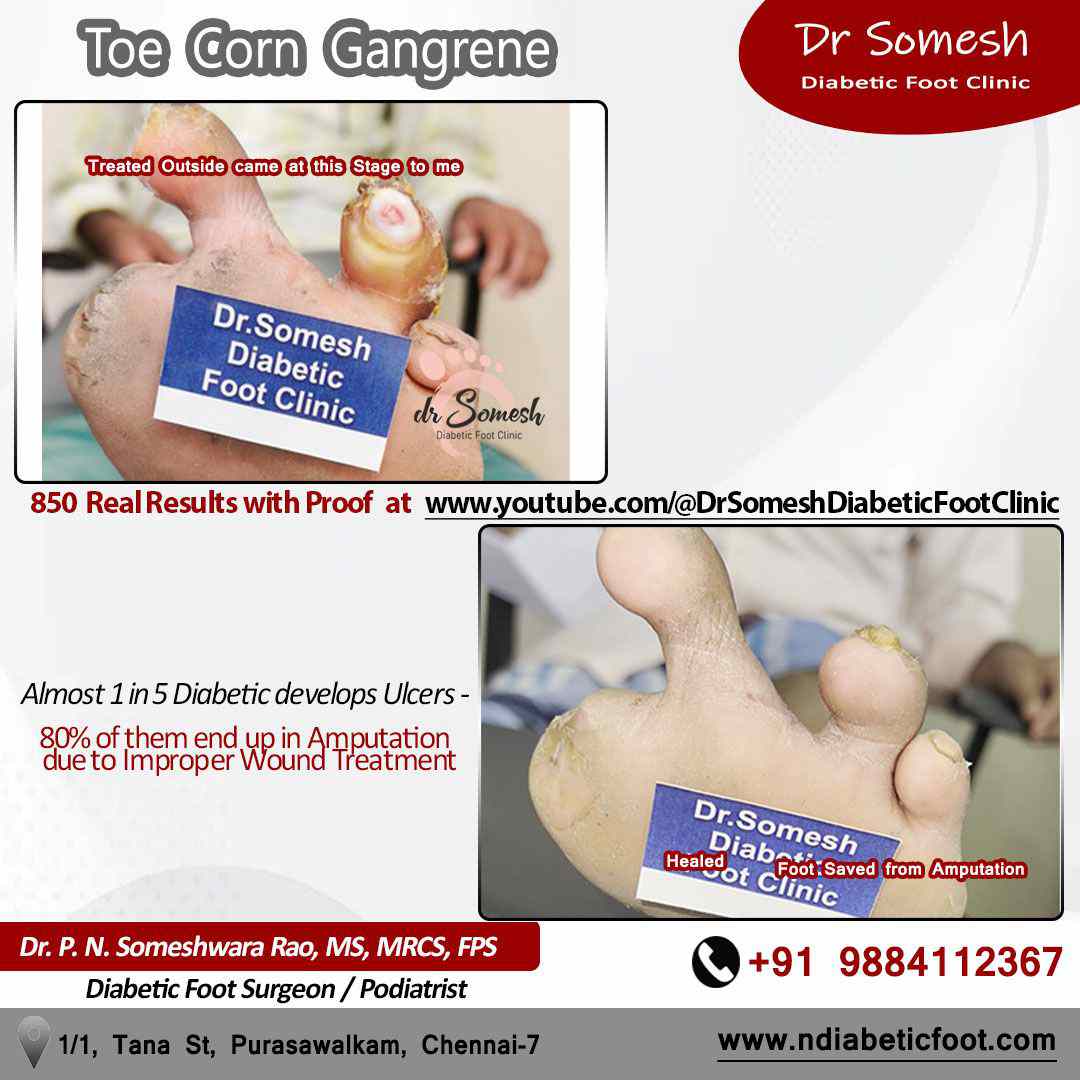 podiatrist chennai | corn foot