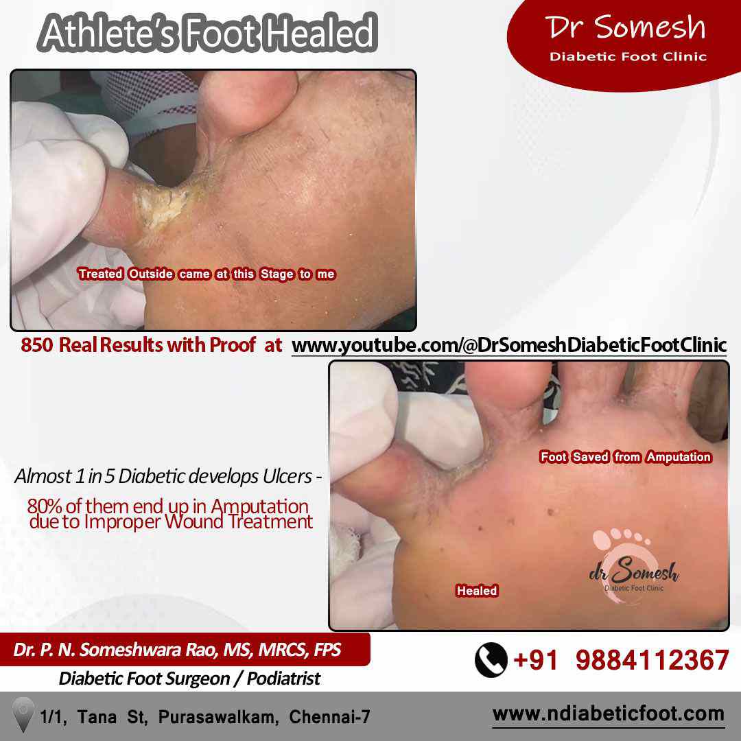 podiatrist chennai | athlete's foot