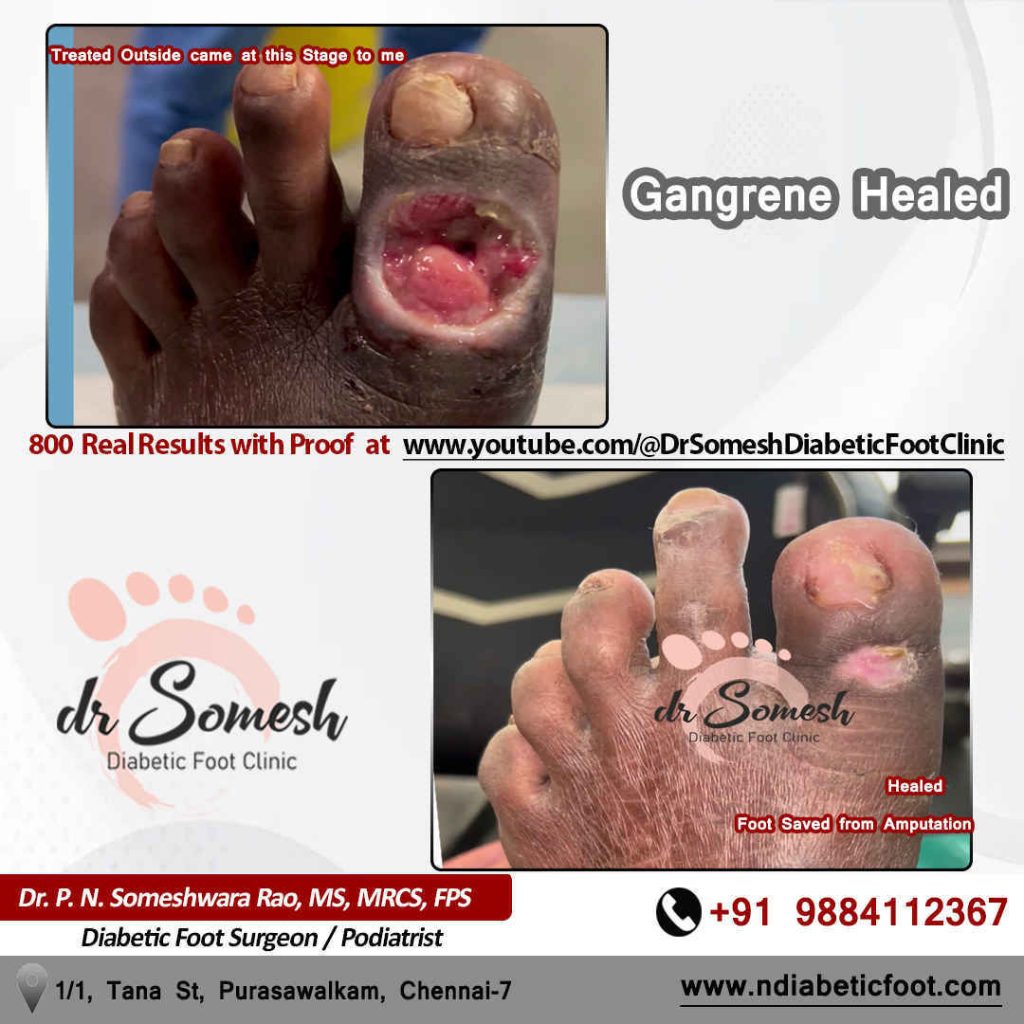 podiatrist chennai | diabetic foot ulcer