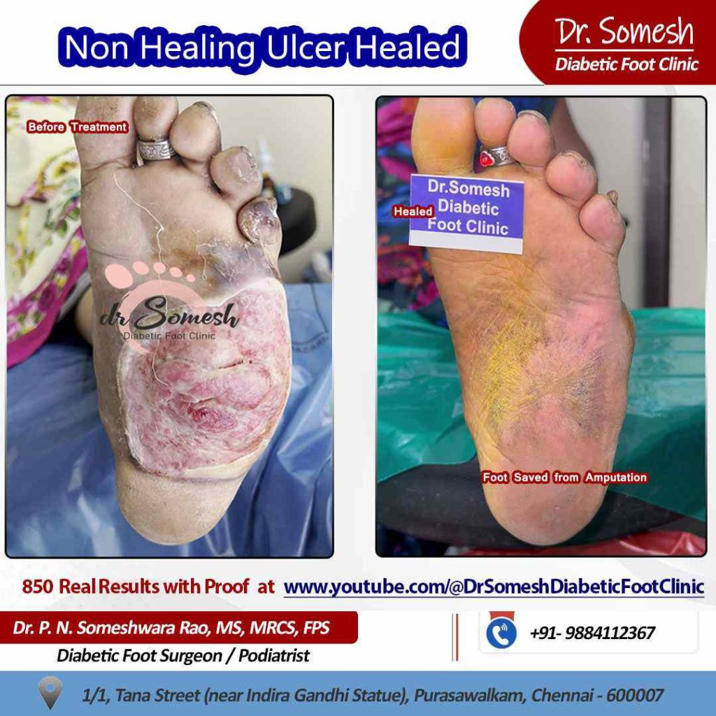 podiatrist chennai | diabetic foot ulcer