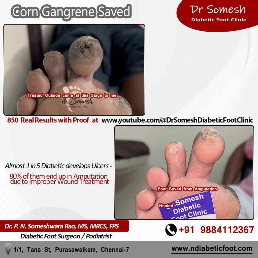 podiatrist chennai | foot corn | nail infection