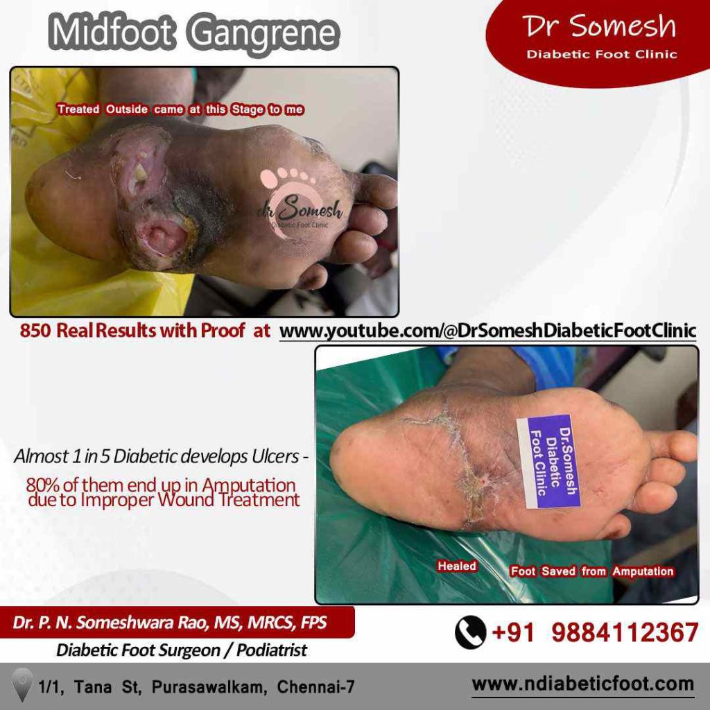 podiatrist chennai | diabetic foot ulcers