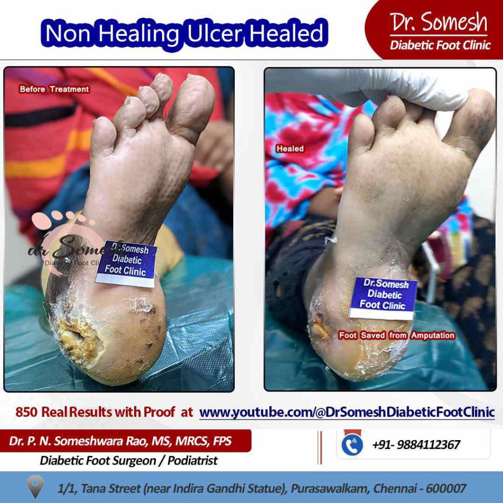 podiatrist chennai | diabetic foot ulcers