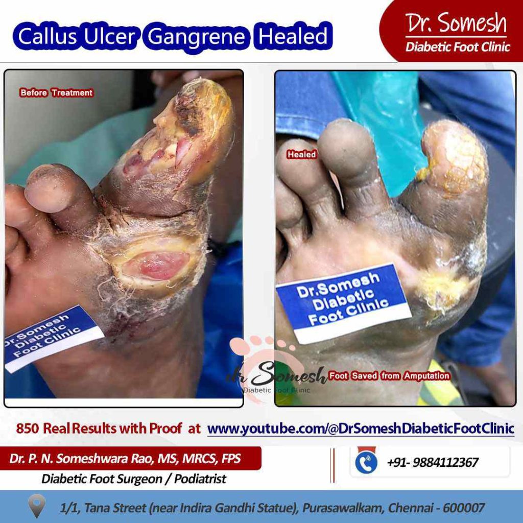 podiatrist chennai | diabetic foot ulcer