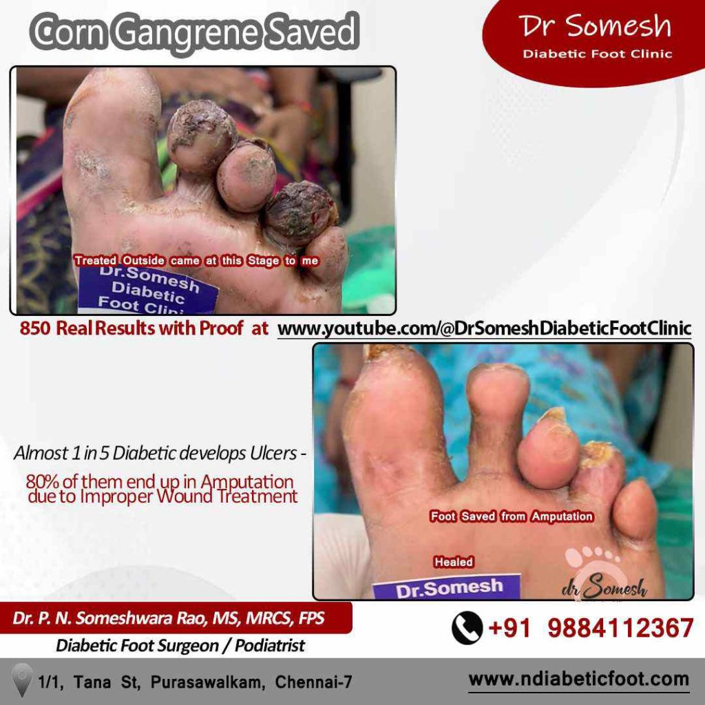 podiatrist chennai | diabetic foot ulcer