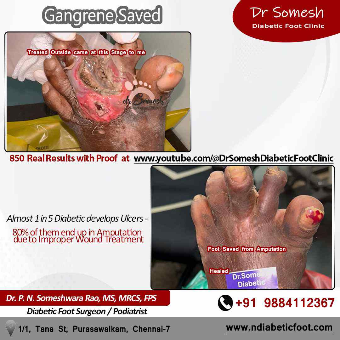 podiatrist chennai | diabetic foot ulcers