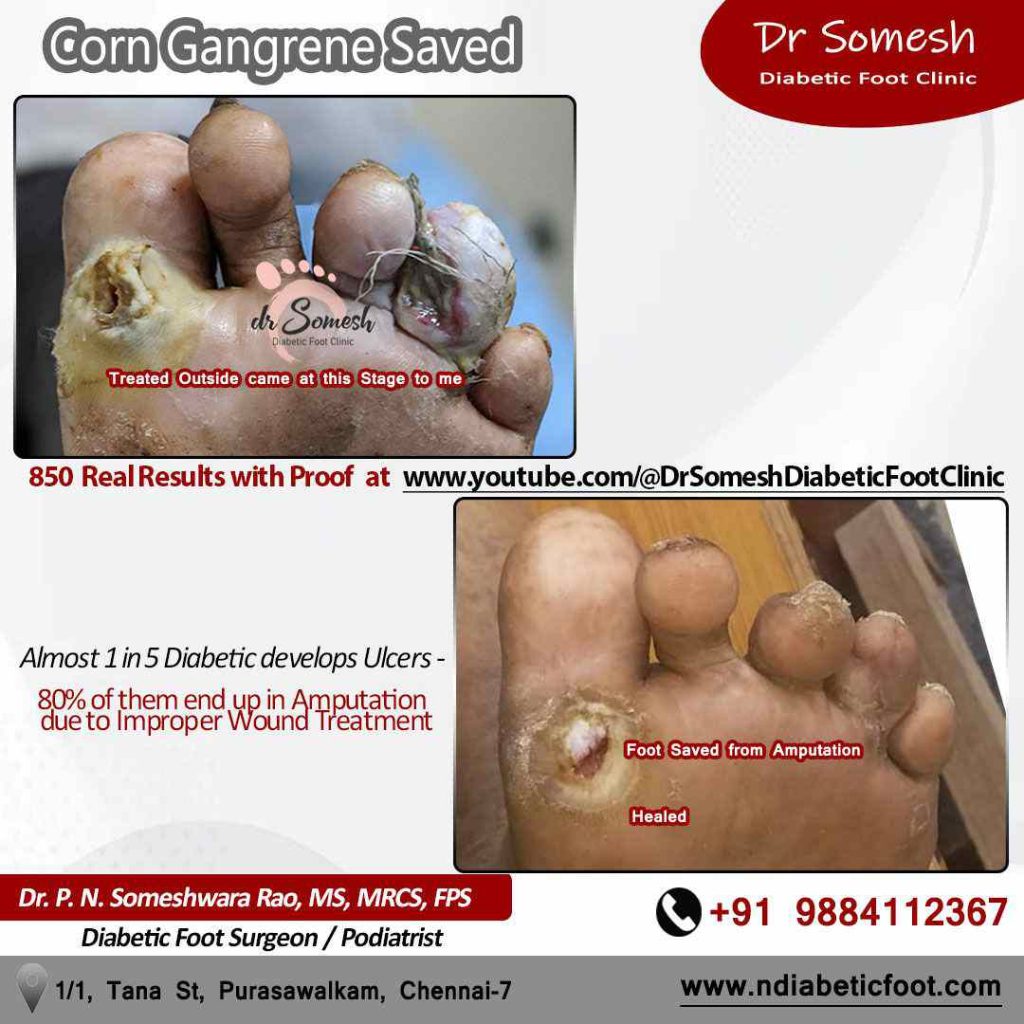 podiatrist chennai | diabetic foot ulcers