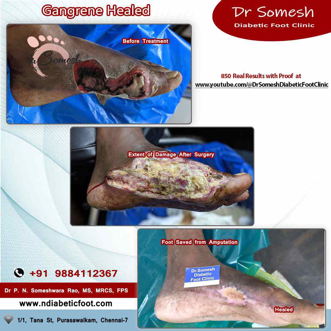 podiatrist chennai | diabetic foot ulcers