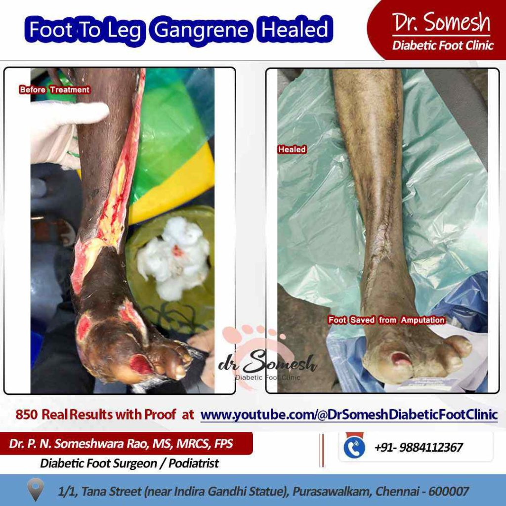 podiatrist chennai | diabetic foot ulcers