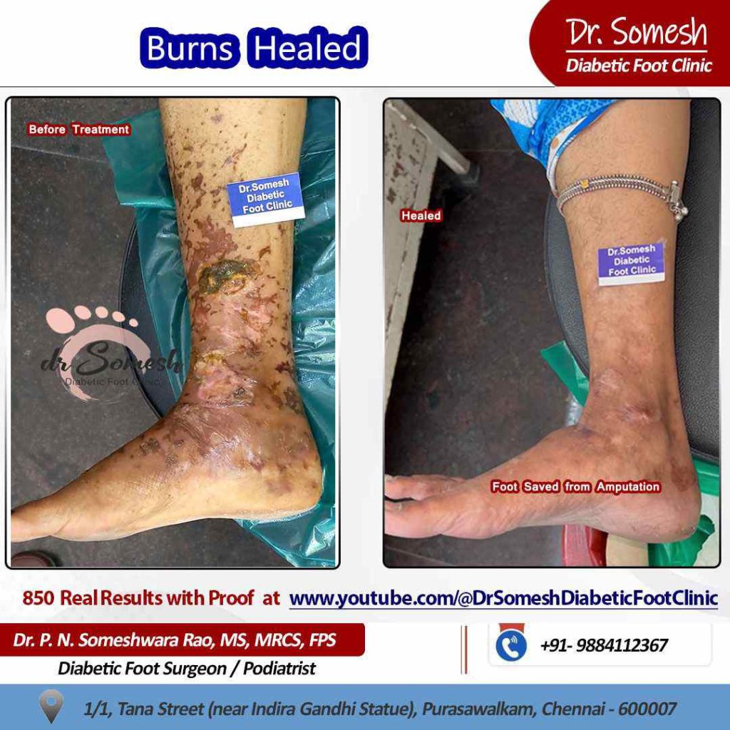 podiatrist chennai | diabetic foot