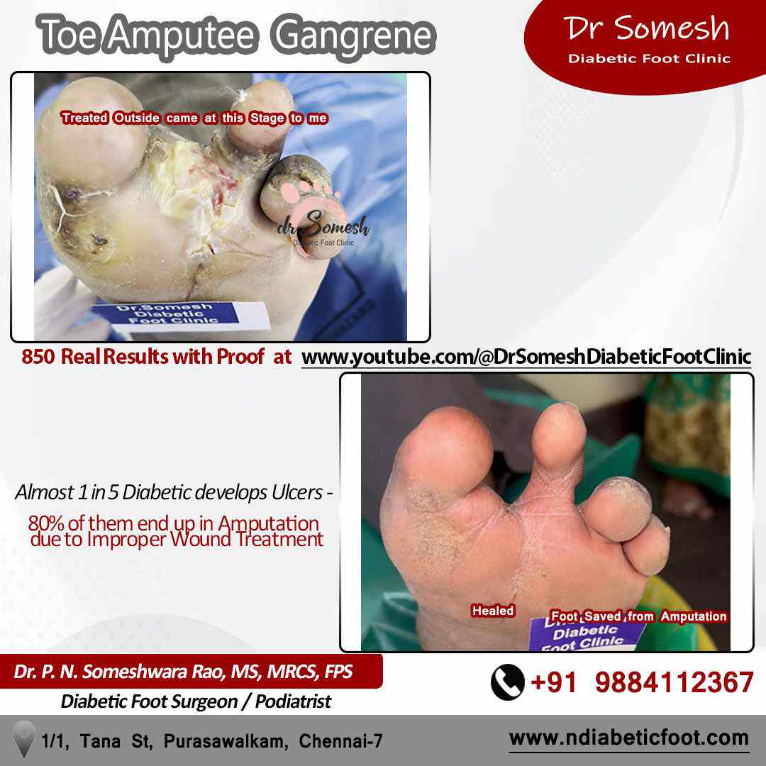 podiatrist chennai | diabetic foot ulcers