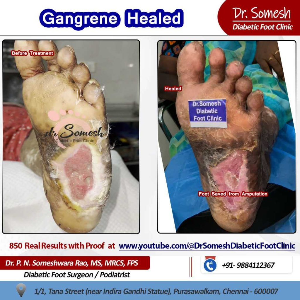 podiatrist chennai | diabetic foot ulcers