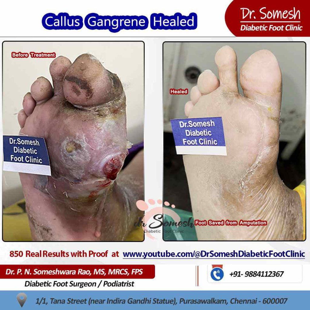 podiatrist chennai | diabetic foot ulcers