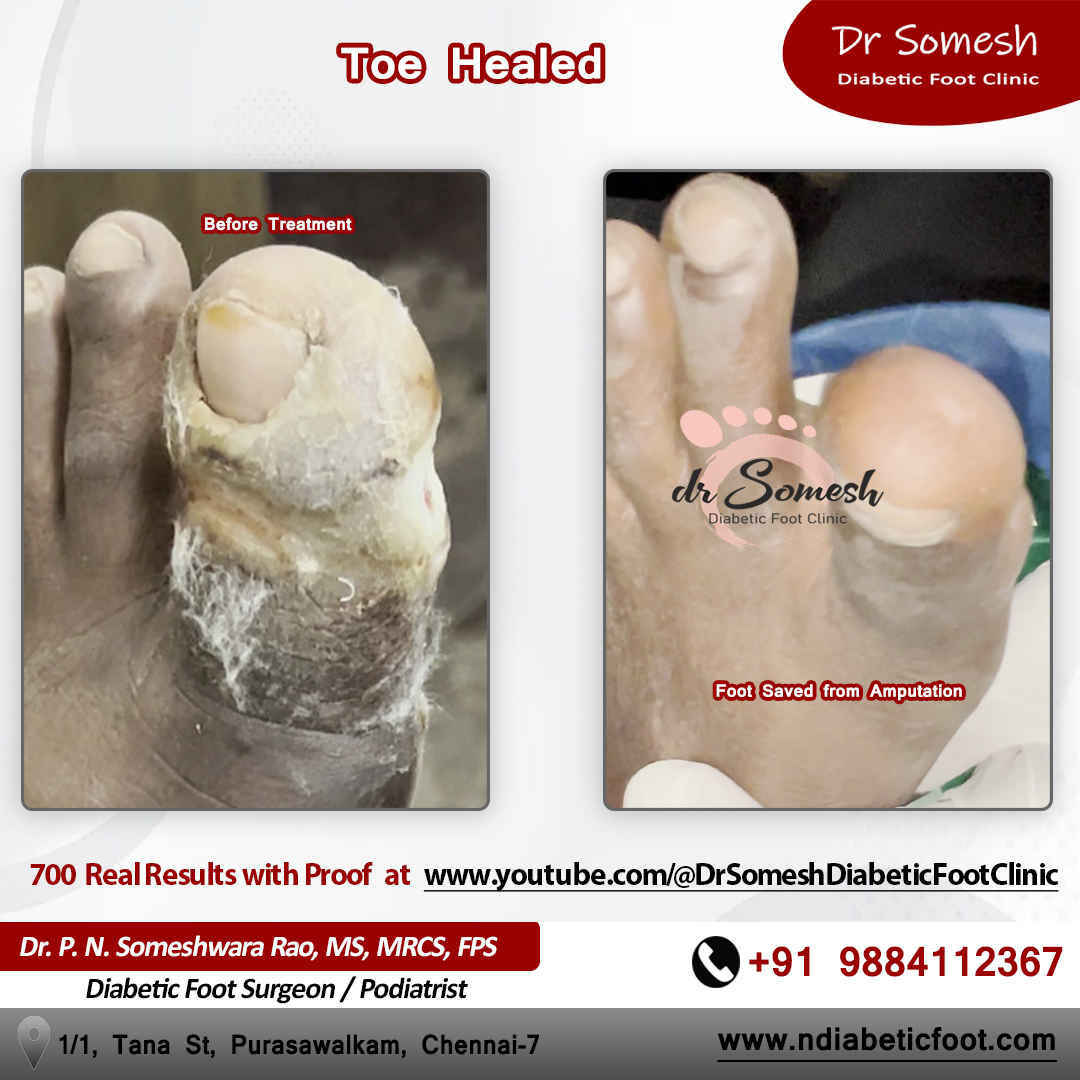 podiatrist chennai | diabetic foot ulcer