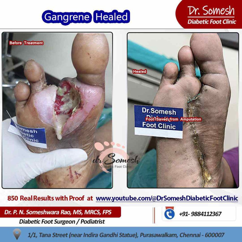 podiatrist chennai | diabetic foot ulcers