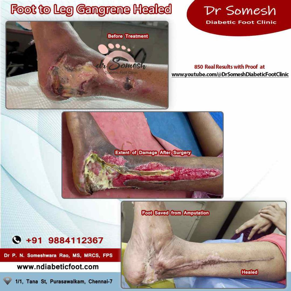 podiatrist chennai | diabetic foot ulcers