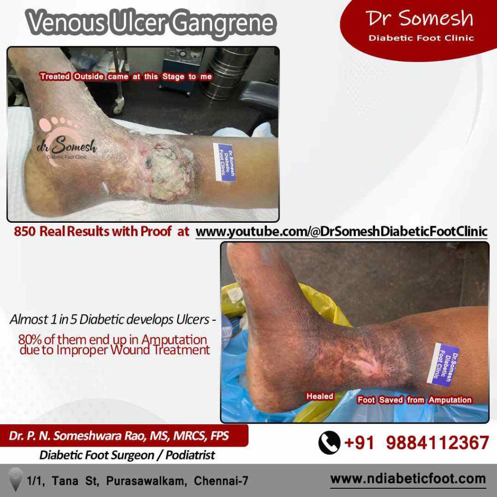 podiatrist chennai | venous ulcers