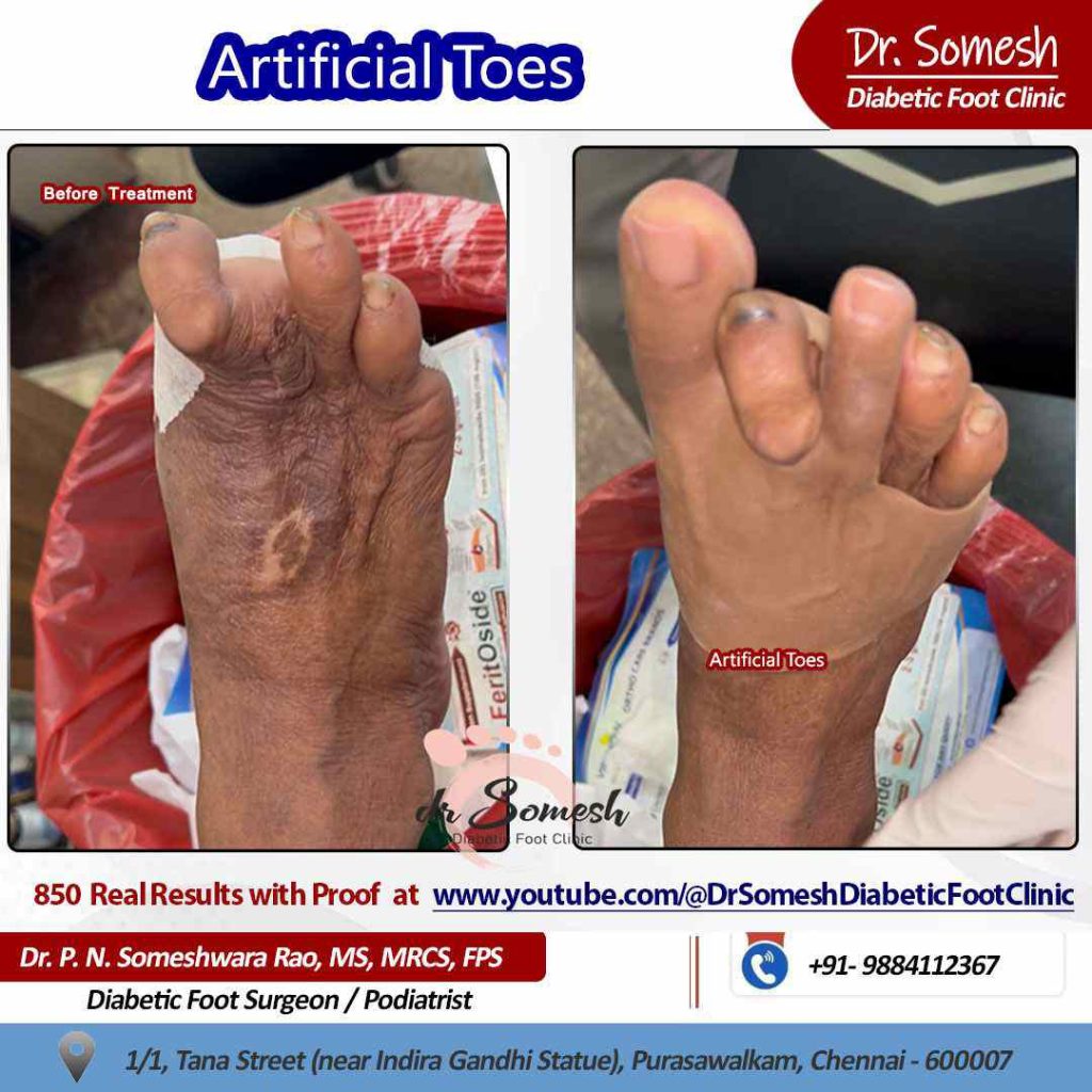 podiatrist chennai | Artificial Toes