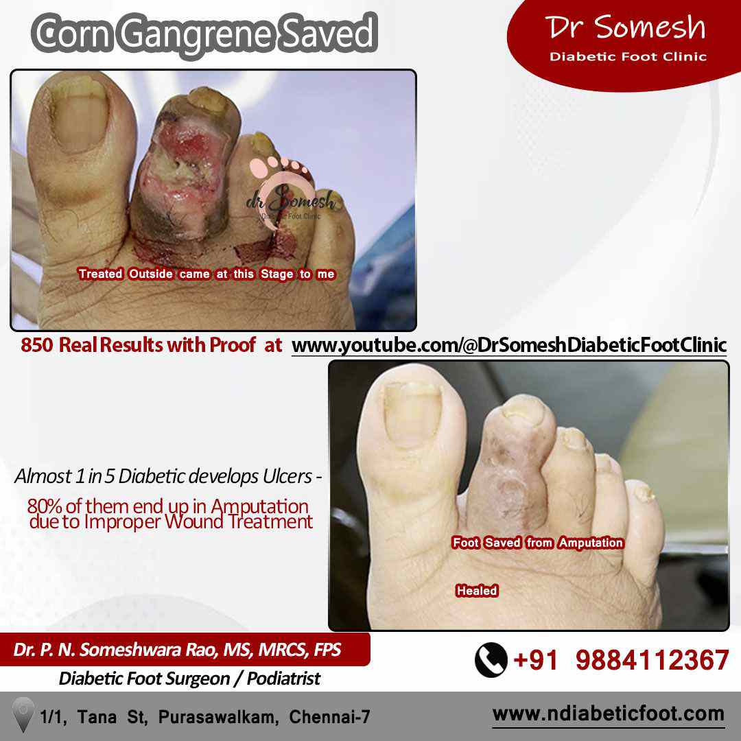 podiatrist chennai | diabetic foot ulcers