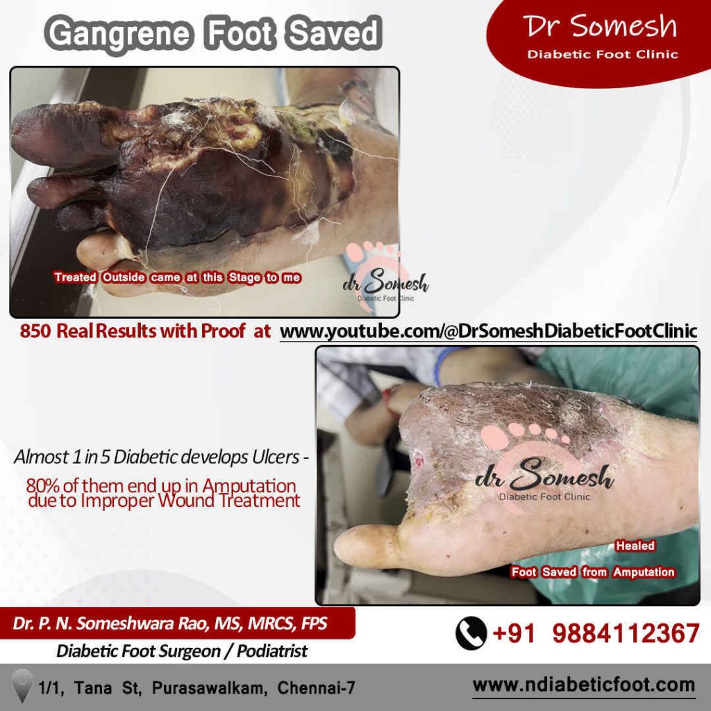podiatrist chennai | diabetic foot ulcer