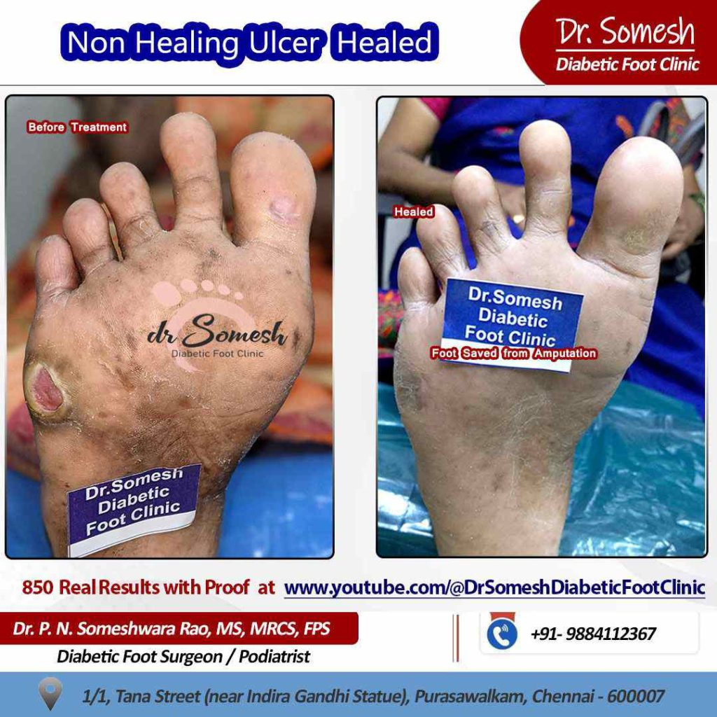 podiatrist chennai | diabetic foot ulcers