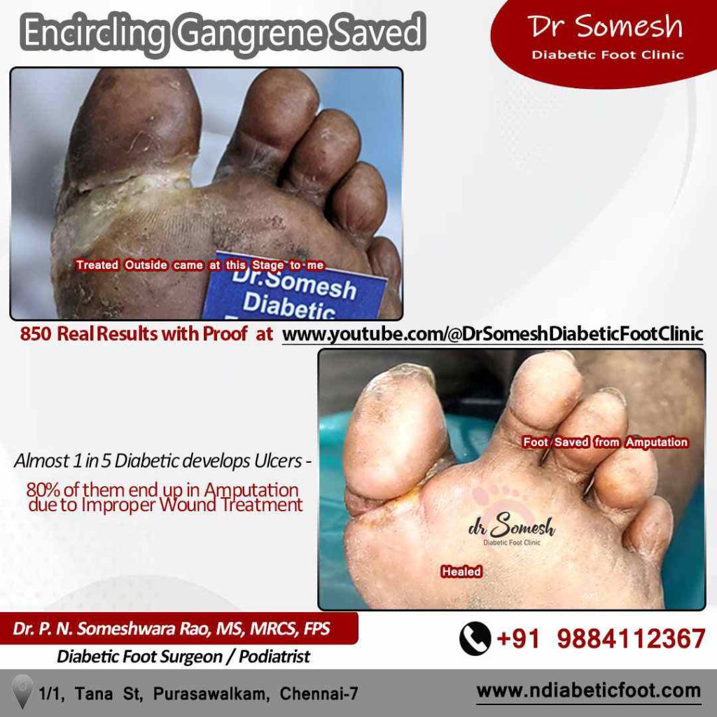 podiatrist chennai | diabetic foot ulcers