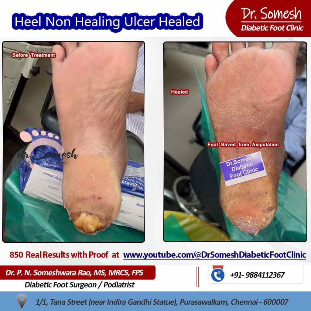 podiatrist chennai | diabetic foot ulcers