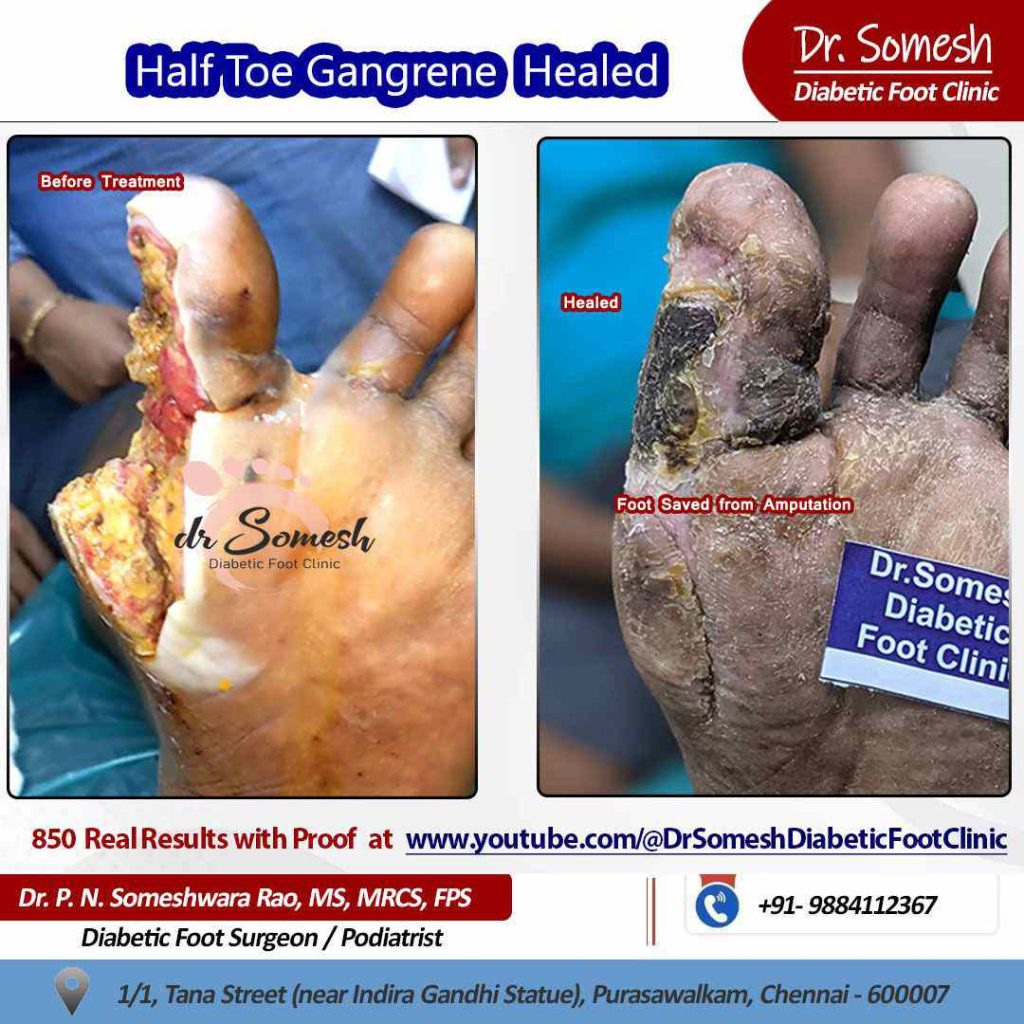 podiatrist chennai | diabetic foot ulcers