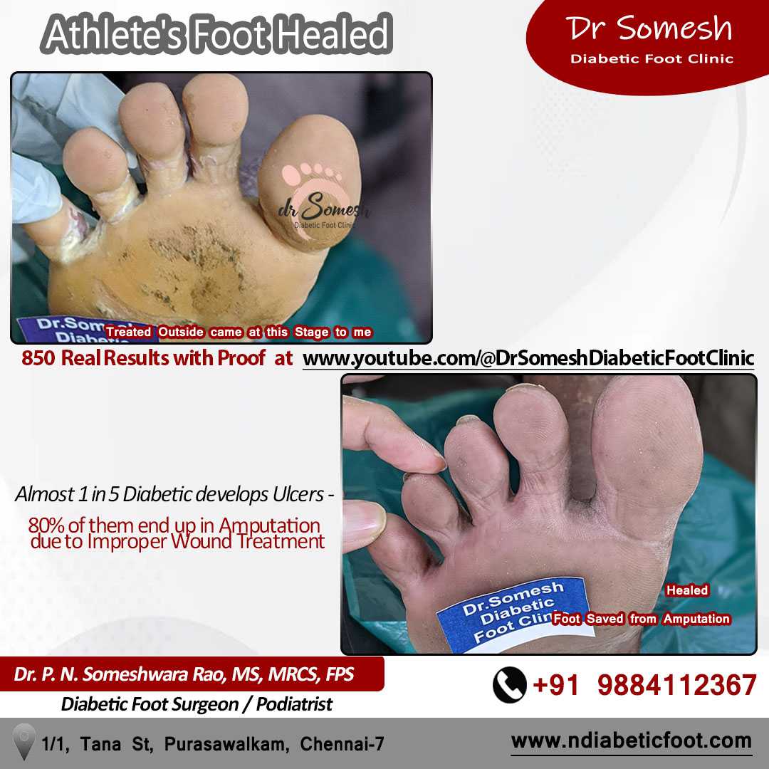 podiatrist chennai | diabetic foot ulcers