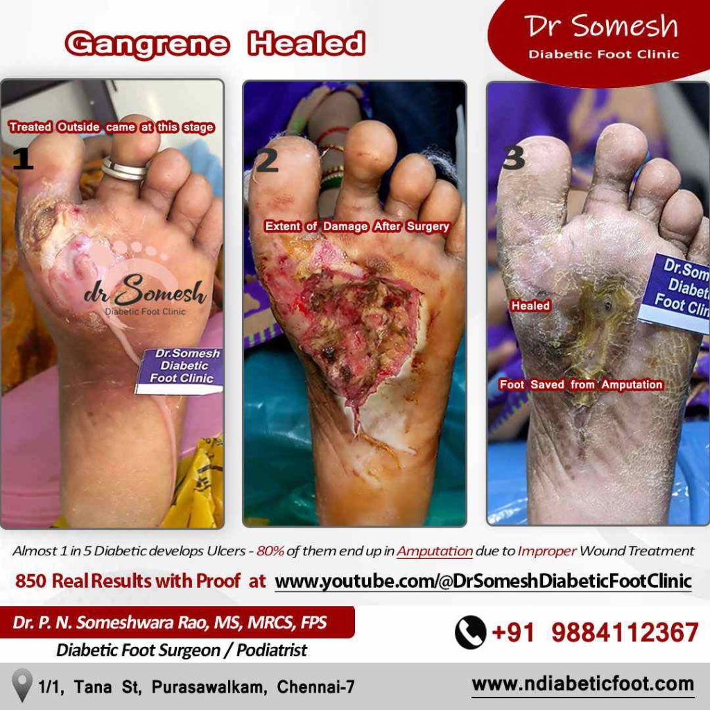 podiatrist chennai | diabetic foot ulcers