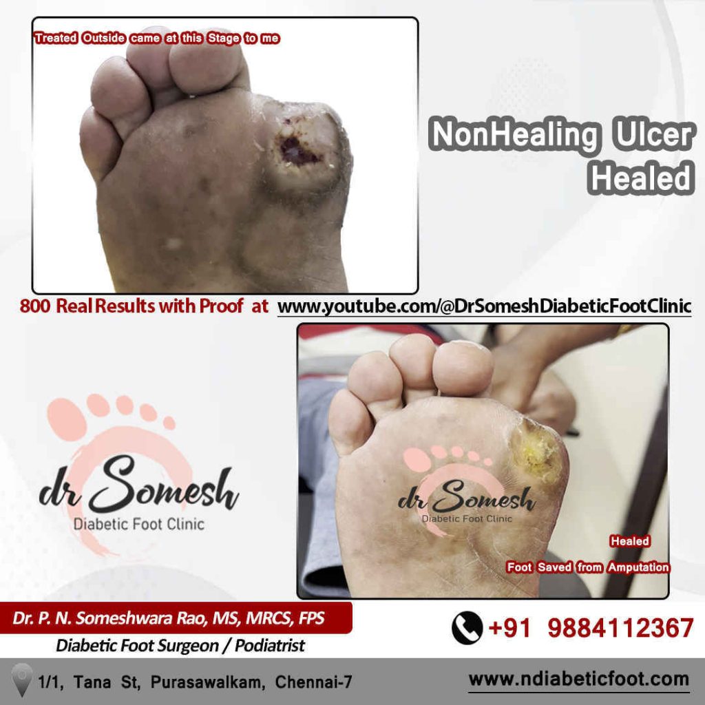 podiatrist chennai | diabetic foot ulcer