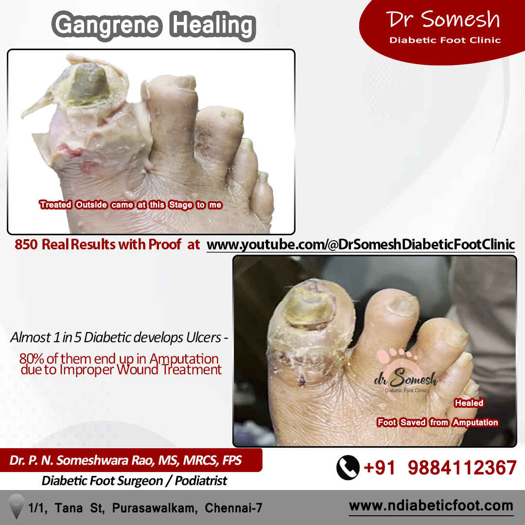 podiatrist chennai | diabetic foot ulcer