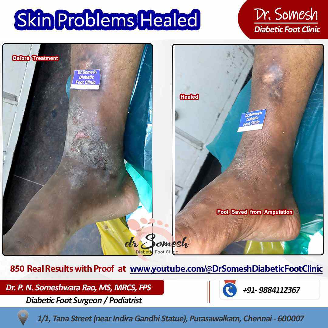 podiatrist chennai | diabetic foot ulcers