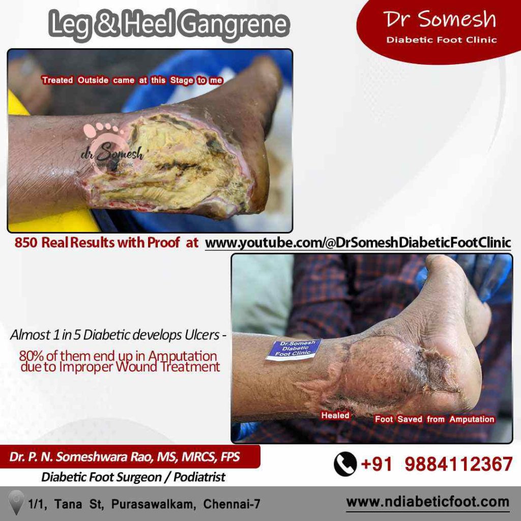 podiatrist chennai | diabetic foot ulcers