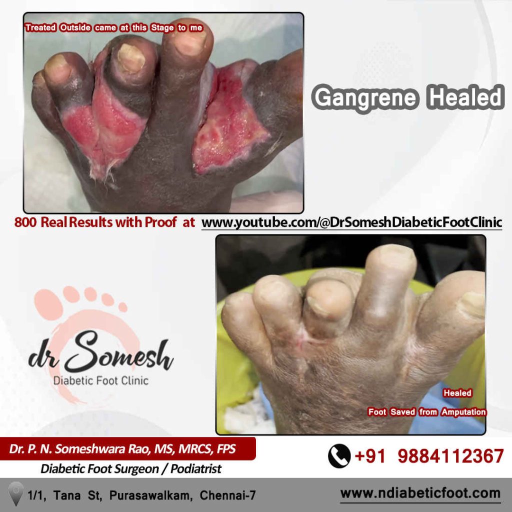 Podiatrist Chennai | Diabetic Foot Infection