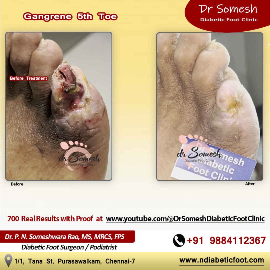 Podiatrist Chennai | Diabetic Foot Infection