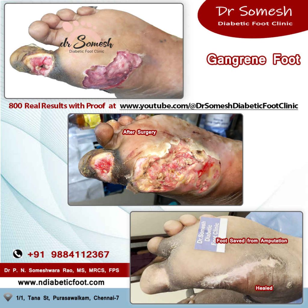 Podiatrist Chennai | Diabetic Foot Infection