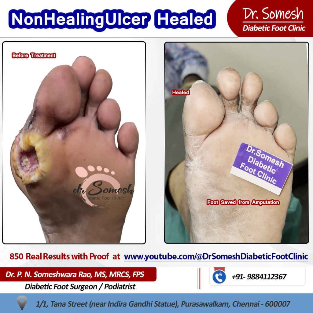 Podiatrist Chennai | Diabetic Foot Infection