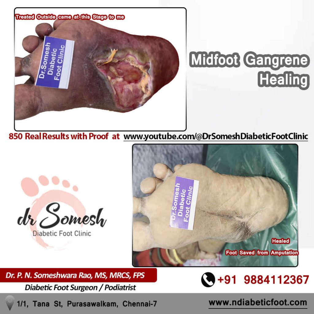 Podiatrist Chennai | Diabetic Foot Infection