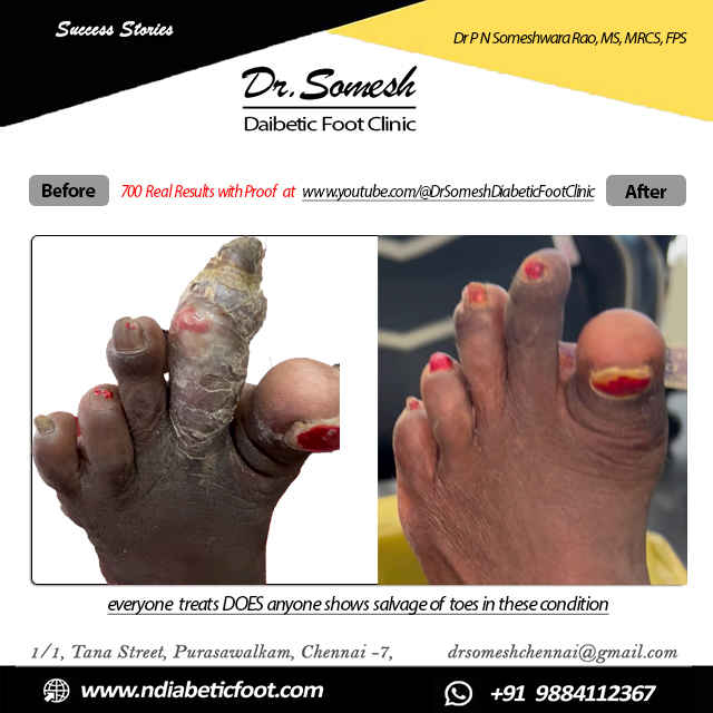 Podiatrist Chennai | Diabetic Foot Infection
