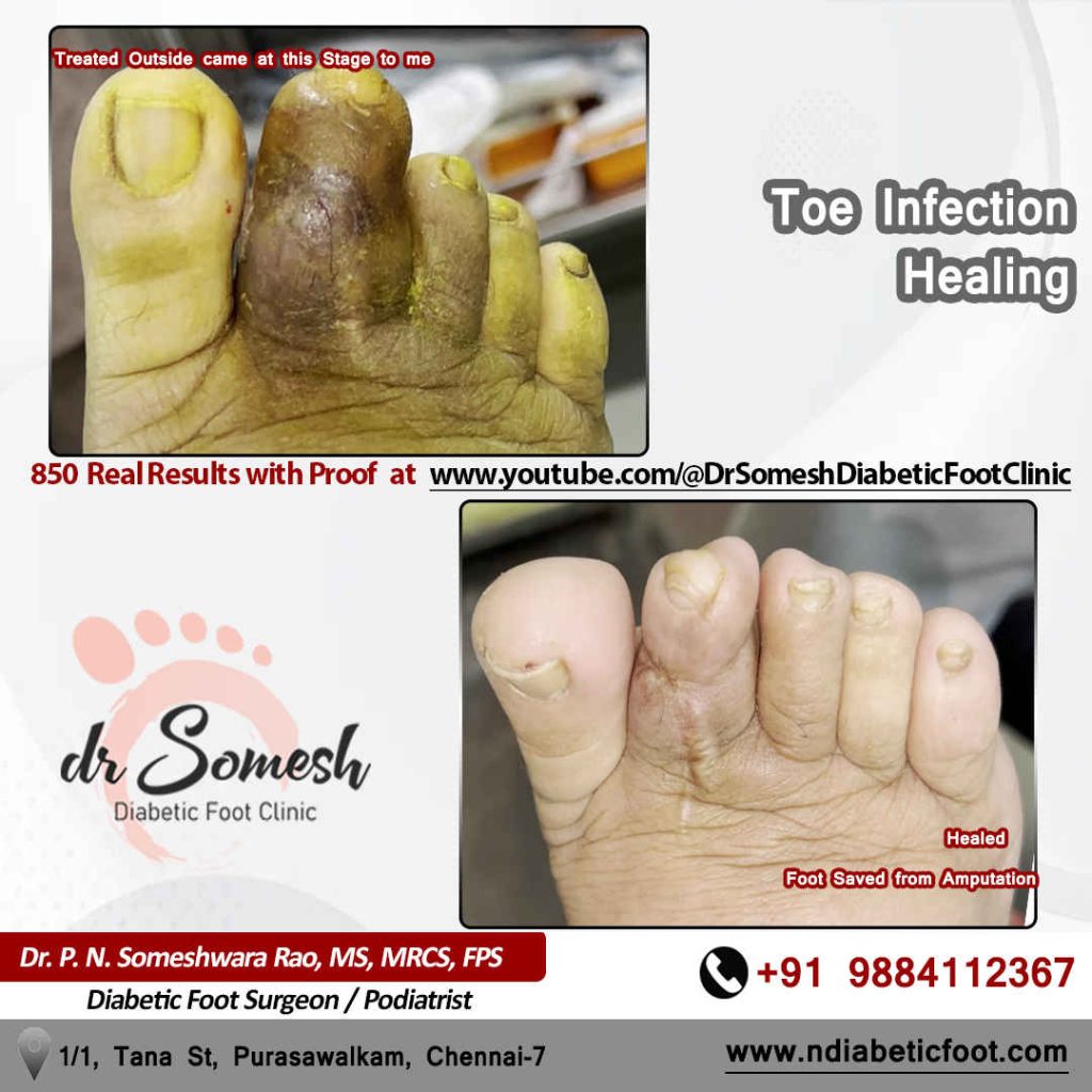 Podiatrist Chennai | Diabetic Foot Infection
