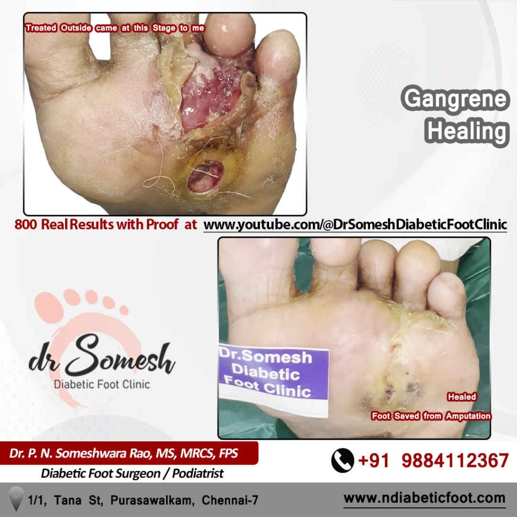 Podiatrist Chennai | Diabetic Foot Infection