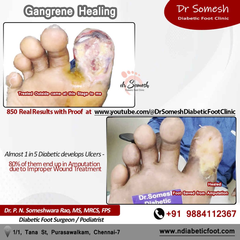 Podiatrist Chennai | Diabetic Foot Infection