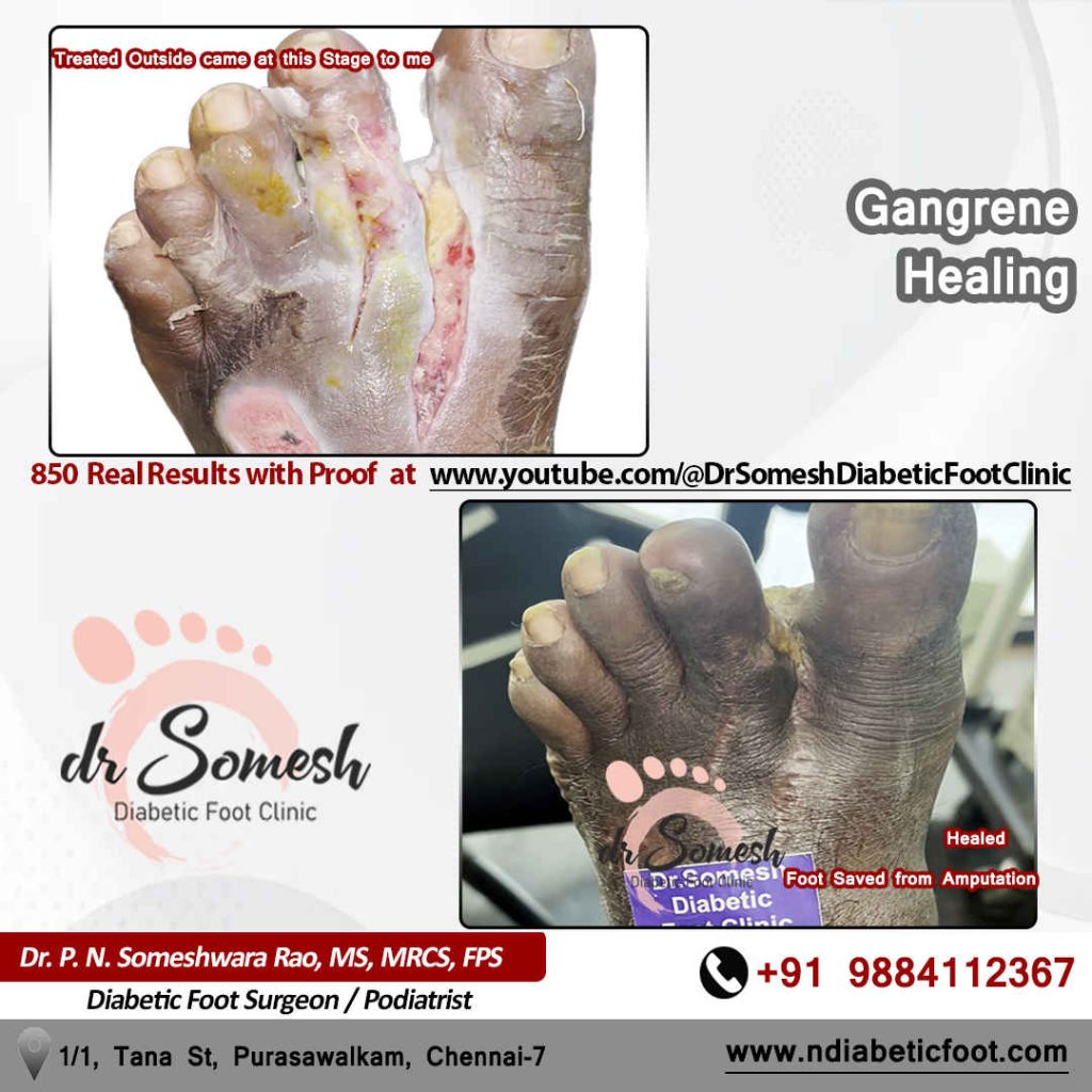 Podiatrist Chennai | Diabetic Foot Infection